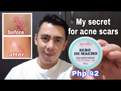 5 TIPS TO REMOVE ACNE SCAR O PEKLAT WITH SEBO DE MACHO OR MUTTON TALLOW SKIN MOISTURIZER | REAL TALK