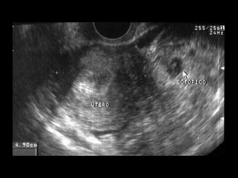 Vídeo: Embarazo Ectópico: Signos, Tratamiento, Causas