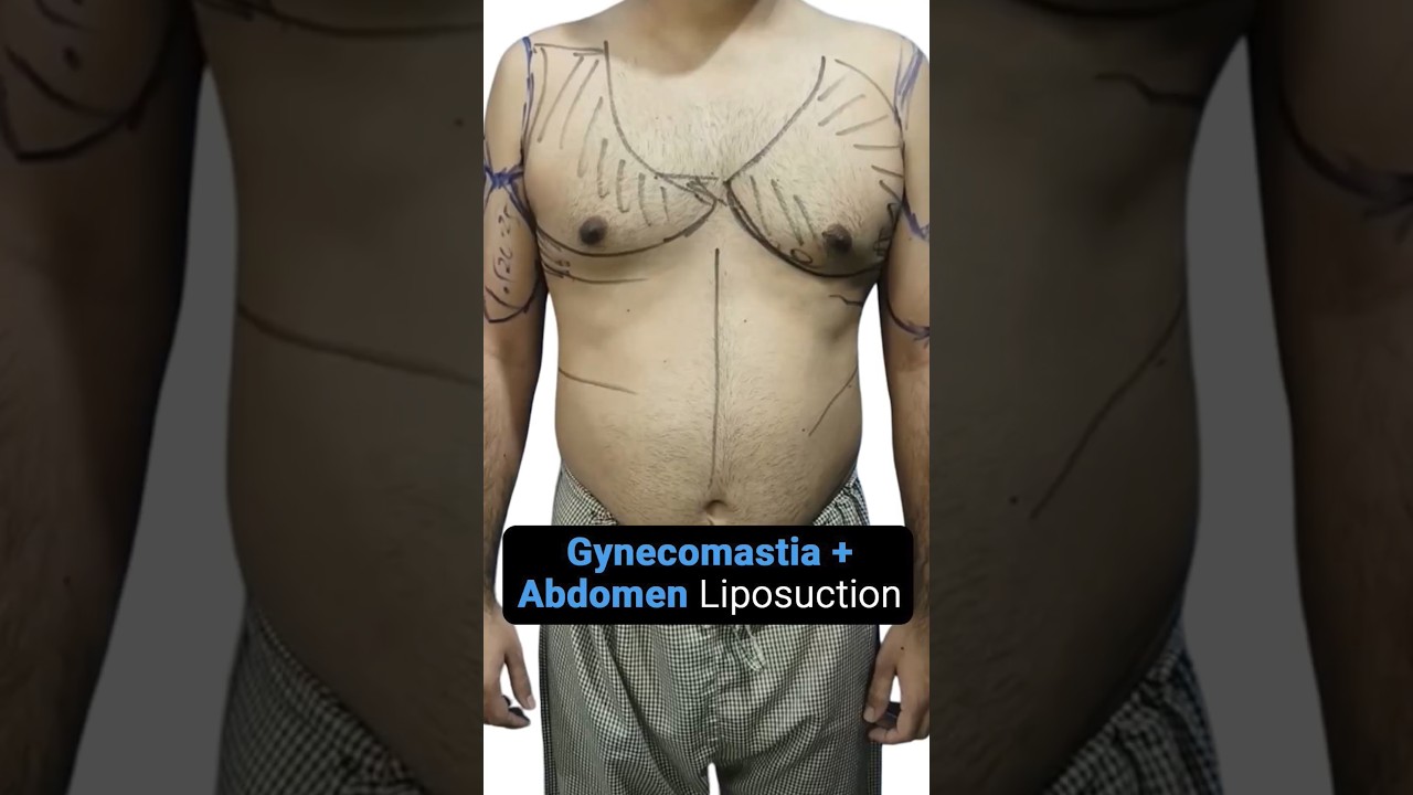 Male Abdominal Liposuction and Gynecomastia Post-Surgery Result! 👌Male Breast Reduction