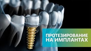 2 главных мифа о зубных имплантах. Что надо знать о протезировании зубов на имплантатах | Дентал ТВ