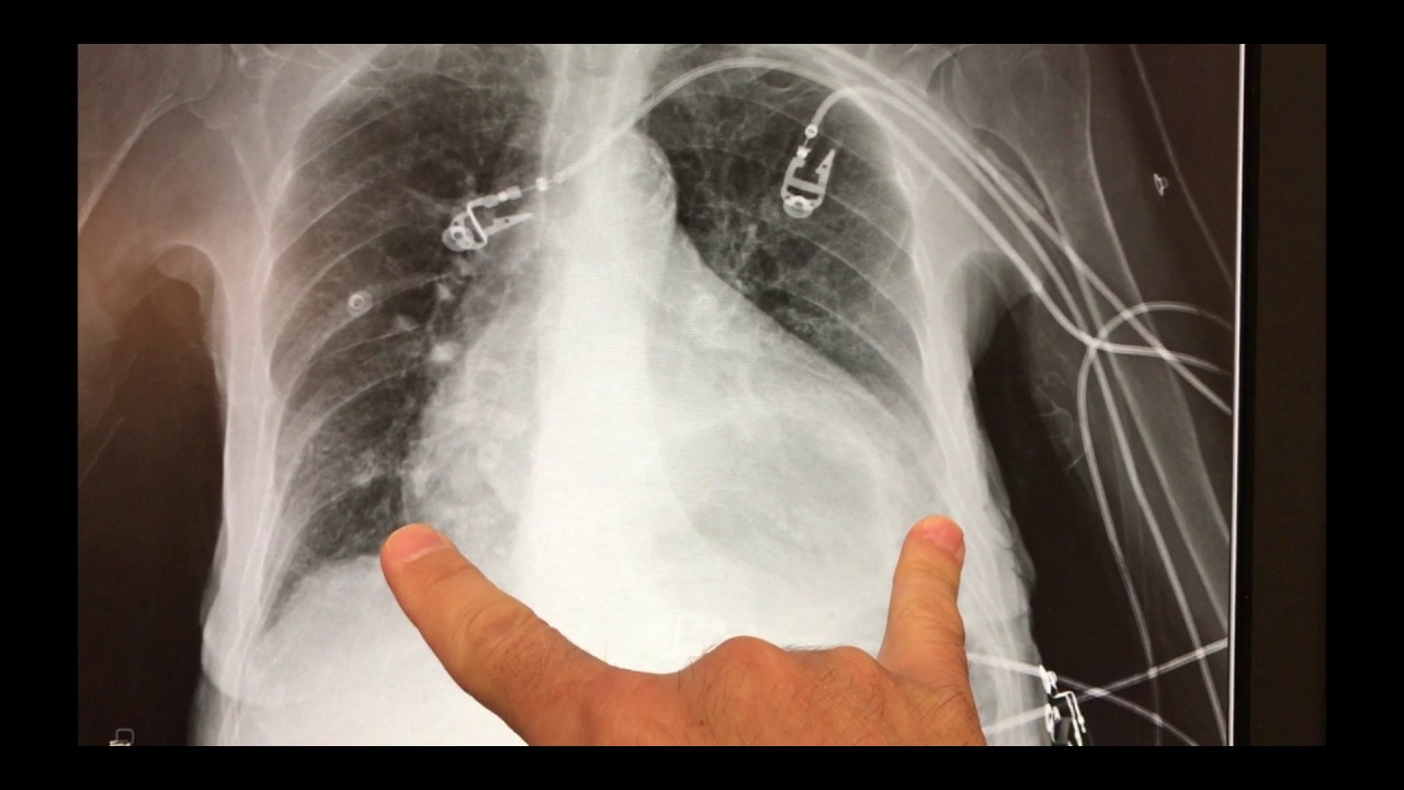 xray interpretation: broken shoulder and large hiatal hernia - YouTube