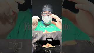 Rinoplastia Primária com Piezo: Refinamento Natural e Harmonioso