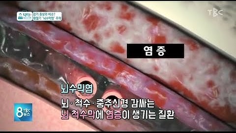 [닥터리포트]감기 증상과 비슷, 뇌수막염 주의