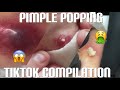 10 Minutes Of Pimple Popping TikTok Compilation