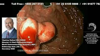 Endoscopic procedure of Glue inject with band ligation screenshot 1