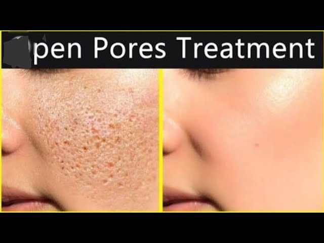 Large Open Pores Treatment at Home || Summer Treatment For Large Open Pores Naturally ||#largepores Large Open Pores Treatment at Home || Summer Treatment For Large Open Pores Naturally ||#largepores