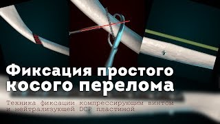 Фиксация простого косого перелома. Остеосинтез при переломе плечевой кости