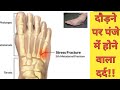 STRESS FRACTURE HINDI FEET - metatarsal stress fracture: mechanism of injury, signs, and treatment