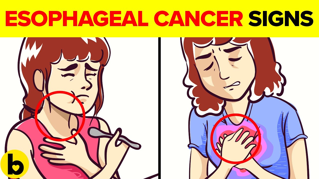 9 Warning Signs & Diagnosis Of Esophageal Cancer