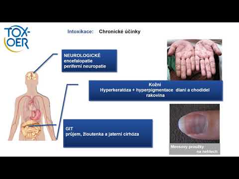 Video: Analýza Methylace Promotoru V Celém Genomu V Neuroblastomu Identifikuje Prognostické Methylační Biomarkery