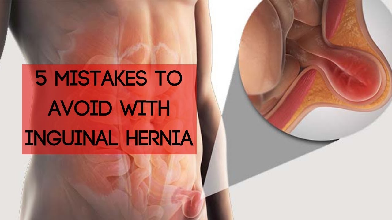 5 Mistakes To Avoid With An Inguinal Hernia - YouTube