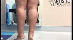 Ankles, Cankles, Calves, Knees | The Best Liposuction | Tampa, Florida, USA - 2 | Expert Dr. Su