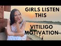 Girls must listen  vitiligo motivation aarti arora    aarus foundation 