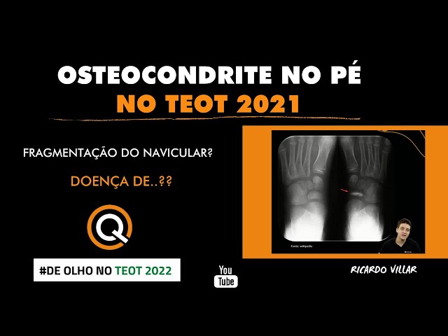 Anatomia do Pé no TARO 2021! Por Ricardo Villar #RevisandoComQuestões #TEOT  #SBOT #OQM 