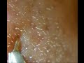 角栓連続ぬき~毛穴パック後~I pulled out keratinplug after the pack of pore