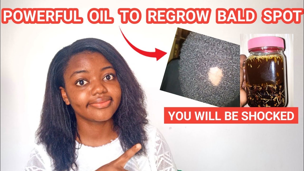 I M LOSING MY HAIR WHAT SHOULD I DO HOW TO REGROW BALD SPOT Relaxed I M LOSING MY HAIR WHAT SHOULD I DO HOW TO REGROW BALD SPOT Relaxed