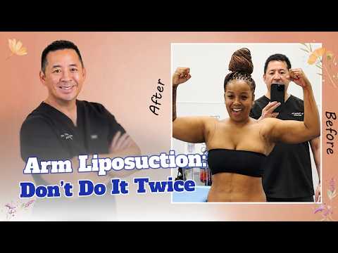 Can you see the difference? 💥 Celebrity Arms™ Liposuction with Dr. Thomas Su 💪 Tampa, Florida