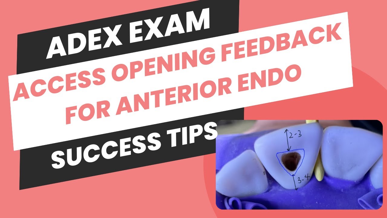Access Opening Feedback For Anterior Endo: Key Adjustments for ADEX Exam Success