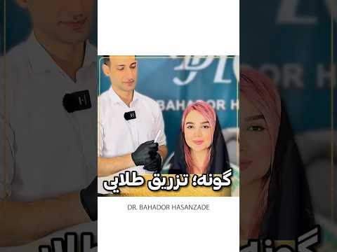 گونه نقطه لیفت صورت