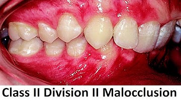 Can Class II Division II of Malocclusion Be Treated With Orthotropics by Prof John Mew
