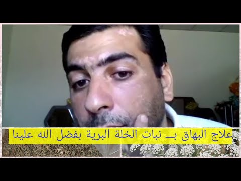 مراحل شفائي 3 بفضل الله علاج البهاق ب الخلة البرية رحمك الله يا امي