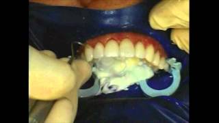 No-Drill DURAthin Veneers