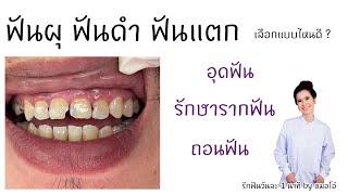 #ปวดฟัน #ถอนฟัน #ฟันผุ เสียวฟัน ฟันผุรักษาอย่างไร ต้องถอนไหม เจ็บไหม/รักฟันวันละ1นาที by หมอโอ๋