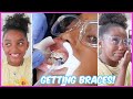 I FINALLY GOT MY BRACES | YOSHIDOLL