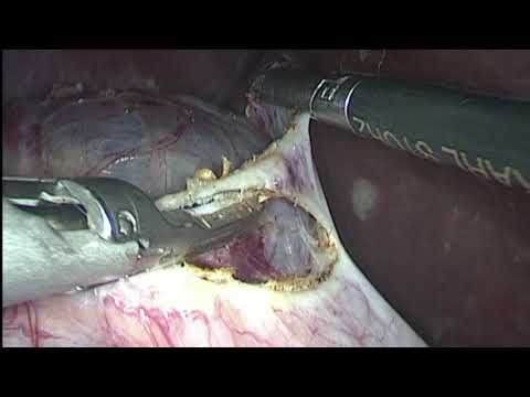 Удаление кисты правой почки