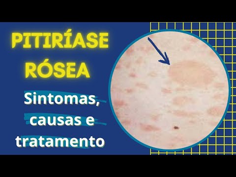 Vídeo: Fungo de Rose Thorns - Informações e sintomas da doença de Rose Picker