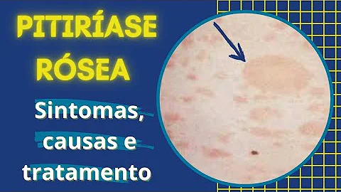 O que provoca a pitiríase?