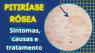 Pitiríase Rósea - sintomas, causa e tratamento