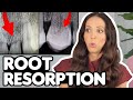 What Is Root Resorption?! (Short Tooth Roots Explained)