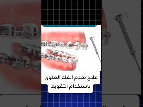 علاج تقدم الفك العلوي طب تجميلاسنان
