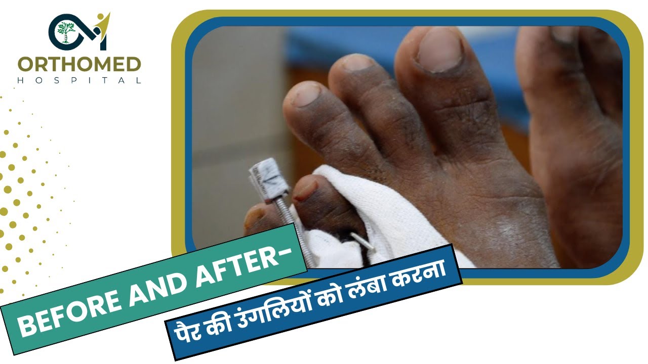 डॉ. संजय अरोड़ा द्वारा पैर की उंगलियों को लंबा करने की सर्जरी | हिसार में सबसे अच्छा अस्पताल I