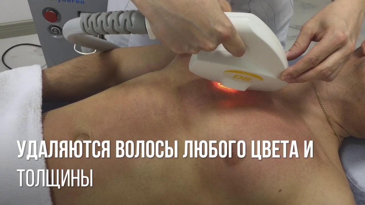 Элос эпиляция - YouTube