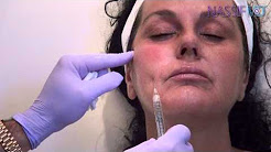 How To Use Blunt Cannula for Facial Fillers | Dr. Paul Nassif