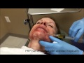 Microneedling with PRP for  Fine Lines around mouth | Dr. Michael Somenek