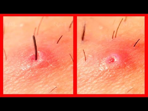 How To Get Rid Of Ingrown Hairs Naturally