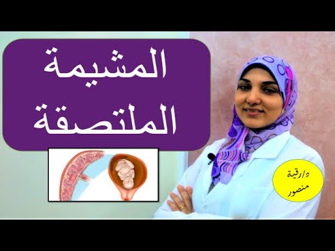 المشيمة الملتصقة | الأسباب والأعراض وطرق العلاج والمضاعفات وعوامل خطورتها