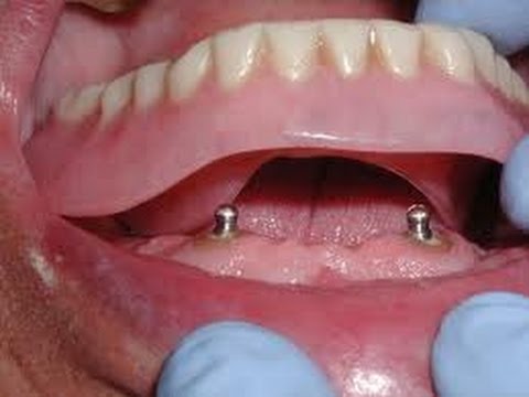 Termoplasztikus fogsor