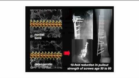 1. The Ankle Injury Management (AIM) Trial and Close Contact Casting (CCC)
