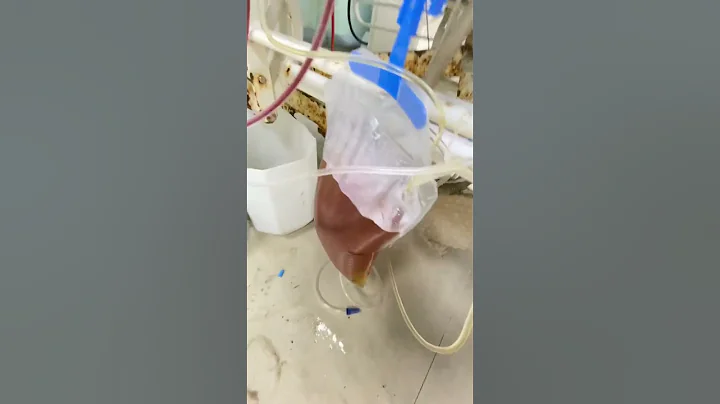 Write the procedure Name ?? #nephrology #uvteam #ndt #shorts #dialysis #plasmapheresis - 天天要聞