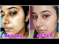 How to Remove Pimples NATURALLY at Home | Pimples Removal Secrets Nobody ever told you | 100% works