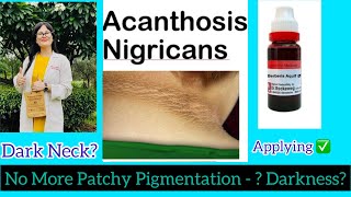 Dark Neck Best Homeopathic MedicineCleaning  Dark Neck  Acanthosis Nigricans Treatment- DrRukmani