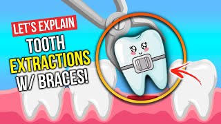 Do Extractions with Braces Have Side Effects?!