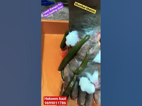 What kind of conditions can leech therapy treat?#leechtherapy#kzhijama#