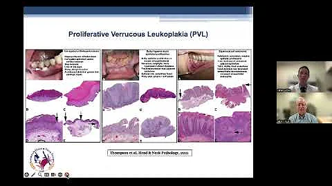 AHNS Virtual Education Series: Beyond Tobacco & Alcohol, Part 2: An Update on Chemoprevention fo...
