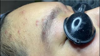 Acne treatment for Spa Linh Mun 2024 #89