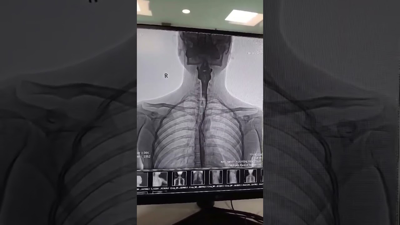 Barium swallow producers ? Barium Swallow test ?